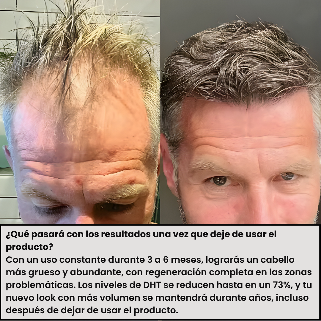 CapilumPro™ Sistema de Crecimiento Capilar